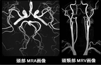 頭頸部領域・非造影血管撮影